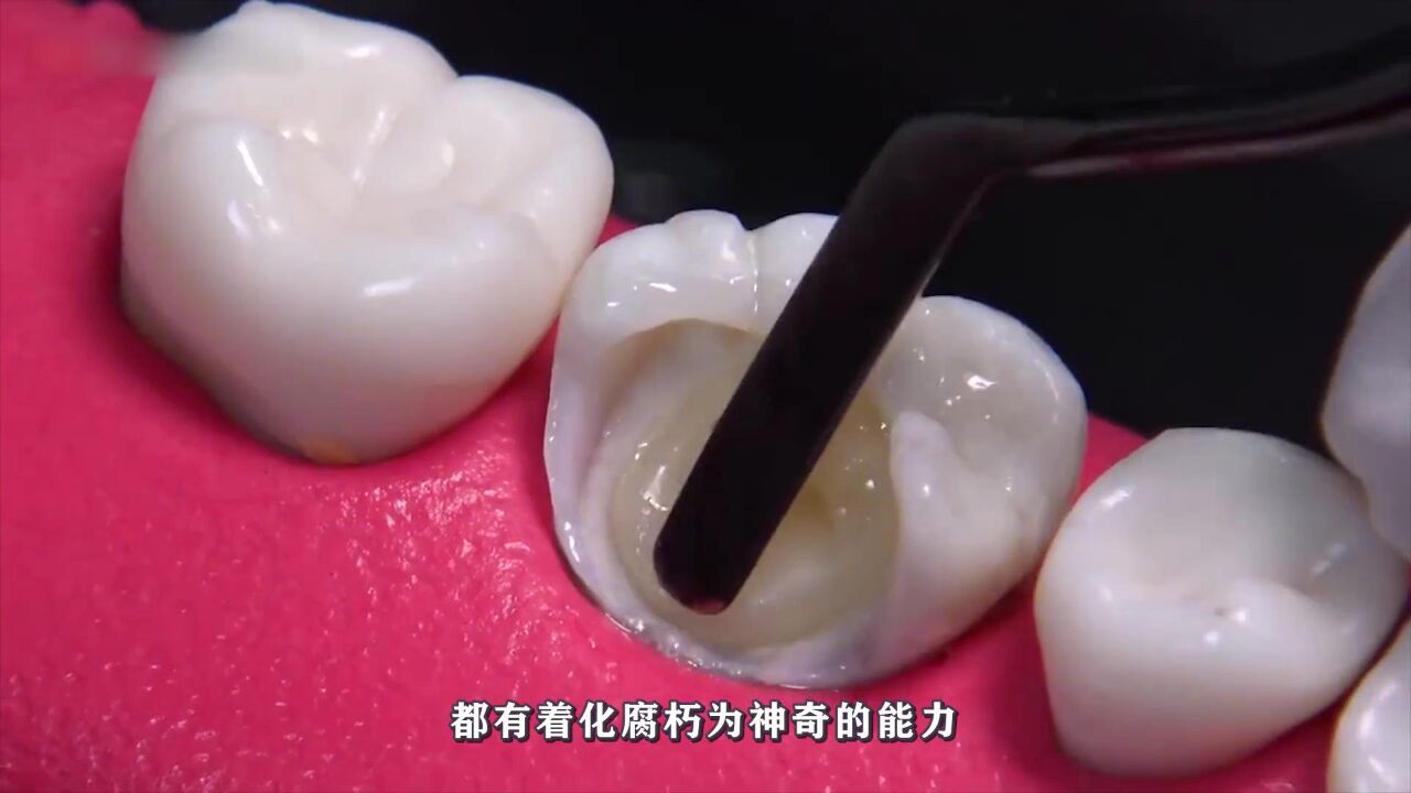 沉浸式补牙，冲洗蛀牙太解压，带你第一视角感受补牙全过程！_腾讯视频