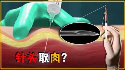 打针时,扎进去的针头里会不会留下“一坨肉”?_高清1080P在线观看平台_腾讯视频