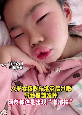 八岁女孩吃布洛芬后过敏导致唇部发肿,网友称这是出现"嘟嘟株".