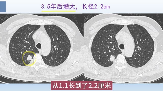 肺结节CT片怎么看?医生举例解析,这个肺癌3年长大1倍