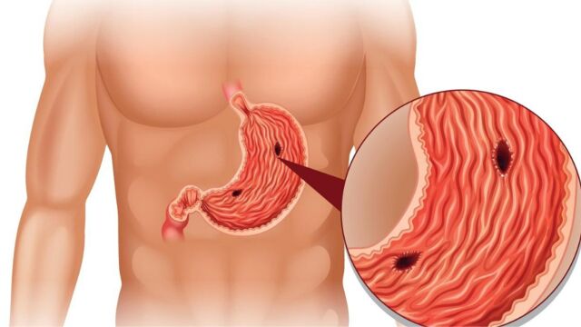 糜烂性胃炎是怎么回事?是胃烂掉了吗?医生一次性给你讲清