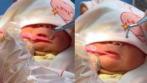 奶爸带刚出生2天的婴儿拔牙，医生撬嘴小心拖拽：龇牙咧嘴看完的