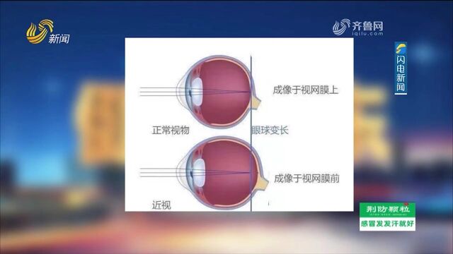 专家讲解近视激光手术矫正近视的原理,全程干货