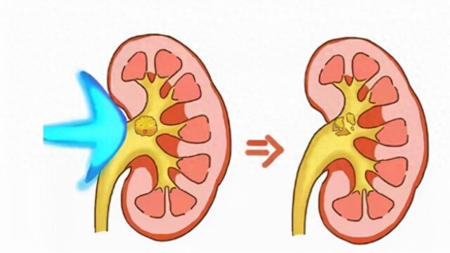 为什么有些医生不建议结石患者做体外碎石?看完你就知道了