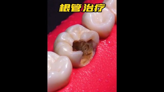 牙齿根管治疗全过程,看完解压又酸爽