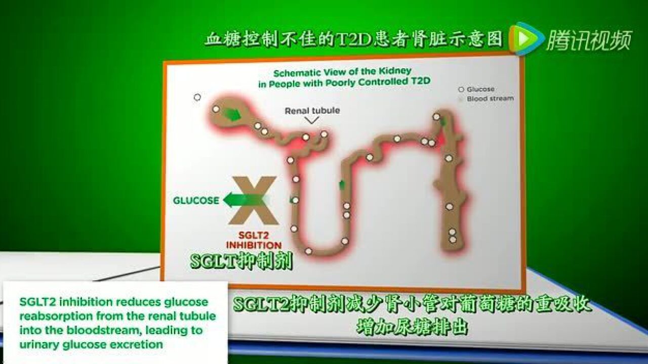 SGLT2抑制剂简介_高清1080P在线观看平台_腾讯视频