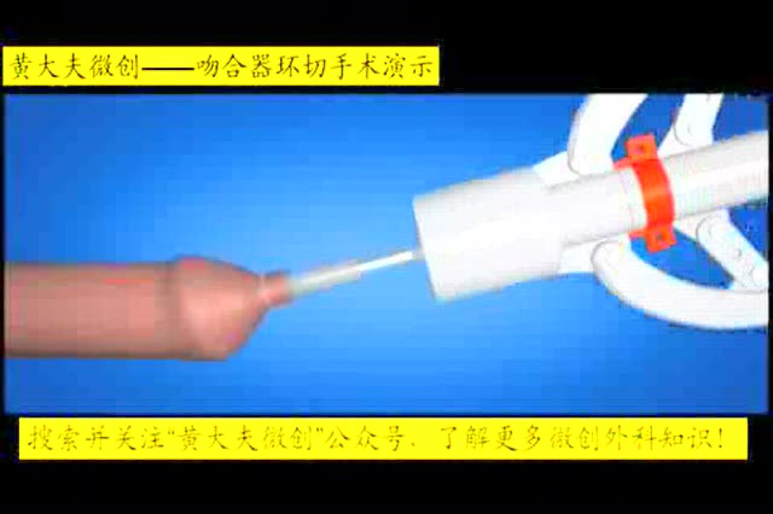 吻合器环切手术演示-1_腾讯视频