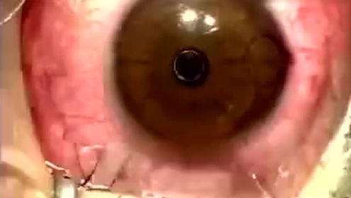 来看看以前治疗近视的眼睛手术是怎么做的，看到浑身酸爽眼睛疼。长见识了！[吃惊]