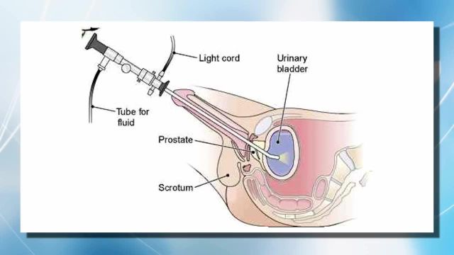 男性膀胱镜检查