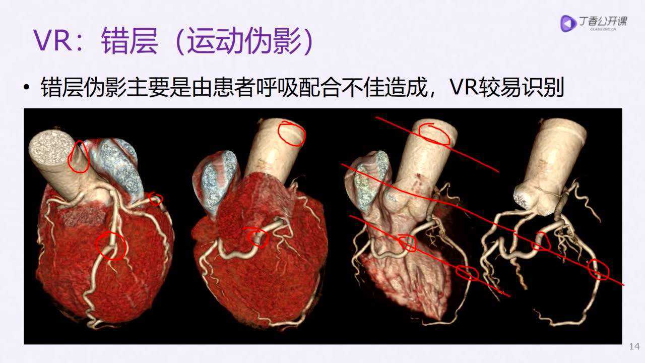 16冠脉篇-冠脉CTA技术:VR、CPR后处理-任福欣_高清1080P在线观看平台_腾讯视频