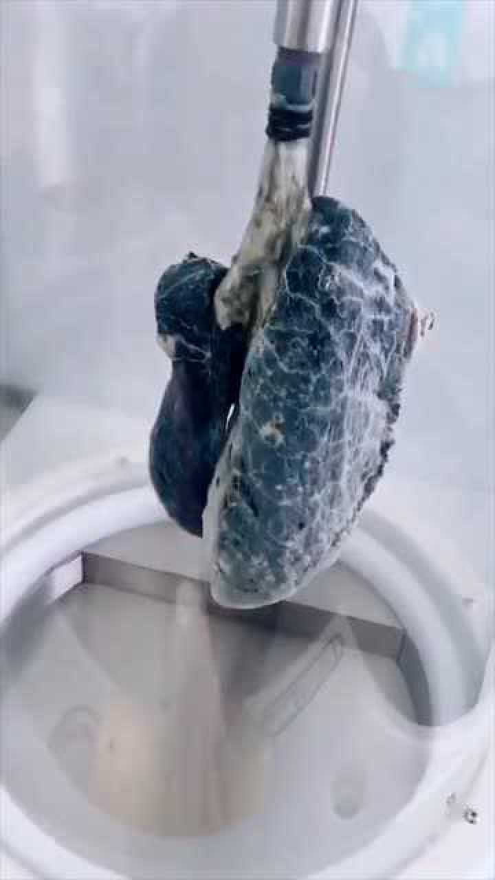十年烟龄的肺图片