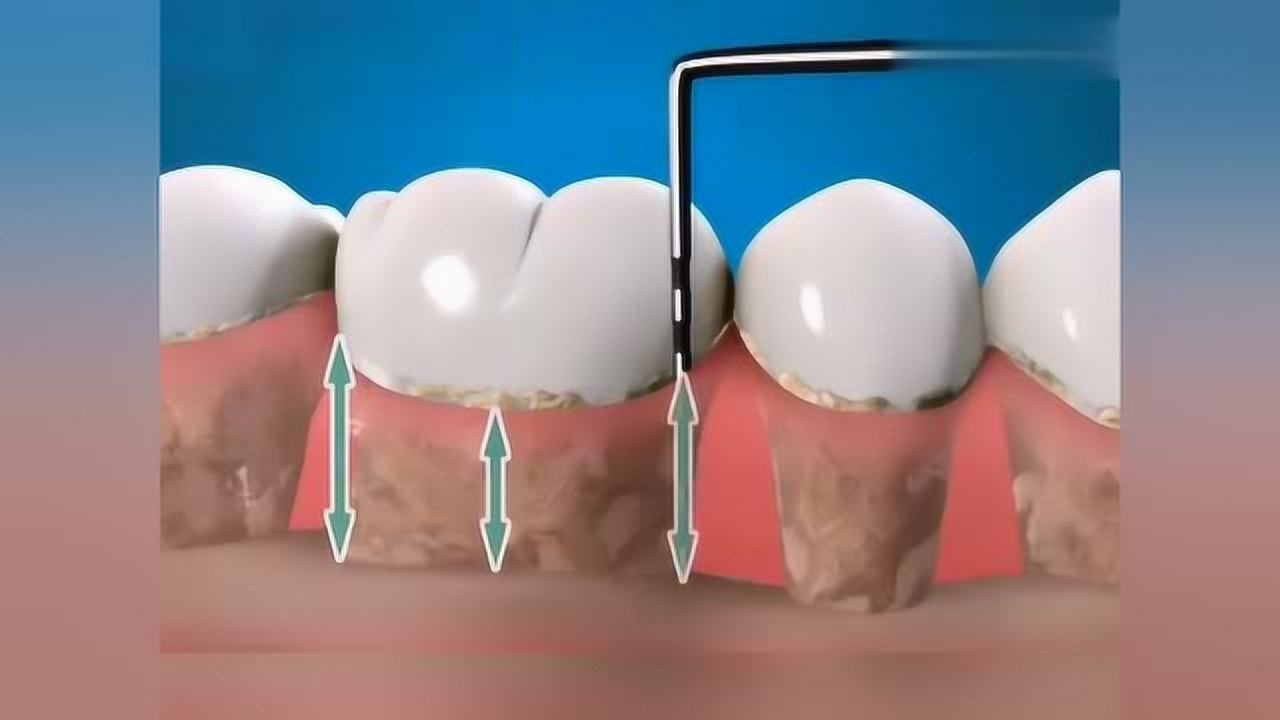 3d动画演示牙周刮治治疗的操作方法