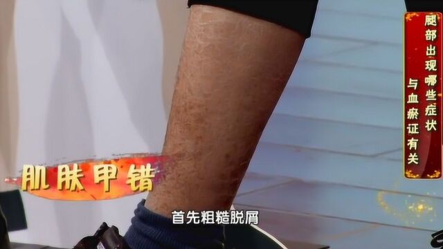 小腿出现粗糙脱屑、瘀斑、水肿,就要警惕了,可能有淤血症了!