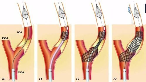 颈动脉支架植入术