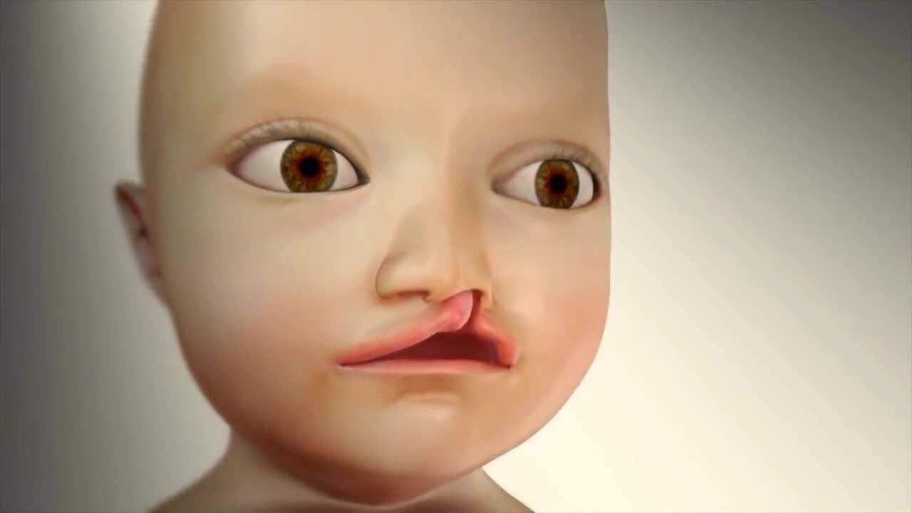小孩天生兔唇怎么办?动画演示:唇裂修复手术全过程,看着真疼!_高清1080P在线观看平台_腾讯视频