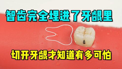 这颗牙齿完全埋在了牙龈里，直到切开牙龈，我才知道有多可怕