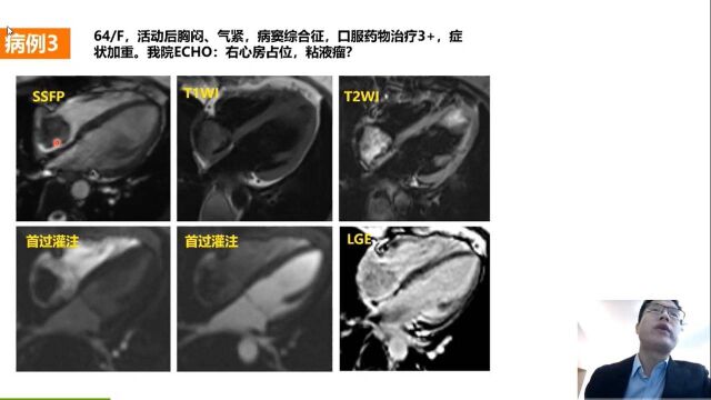 心脏占位性病变CT&MRI评价华西医院彭礼清