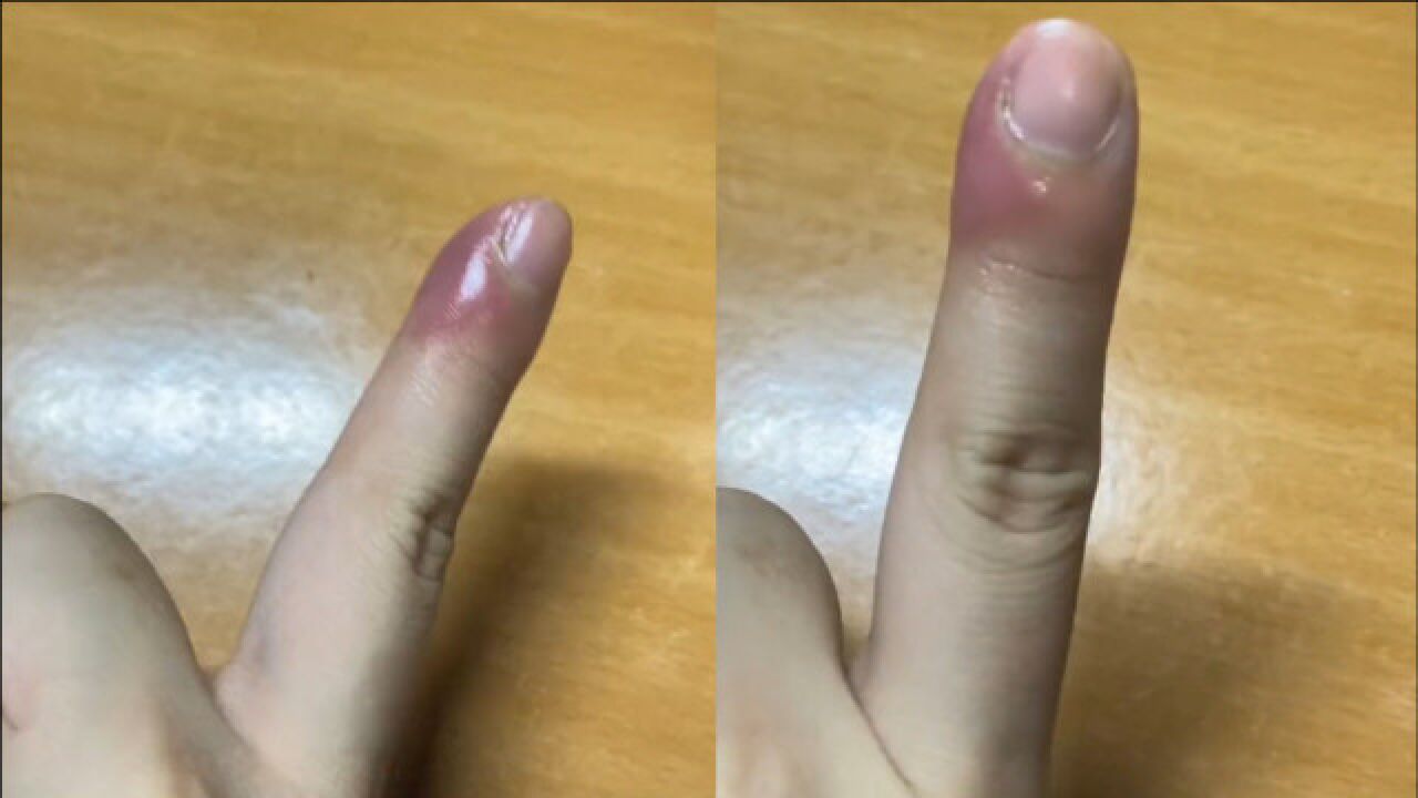 女子拔倒刺手指肿一周,上网一查危害吓得引起重视:不是化脓就是截肢_高清1080P在线观看平台_腾讯视频