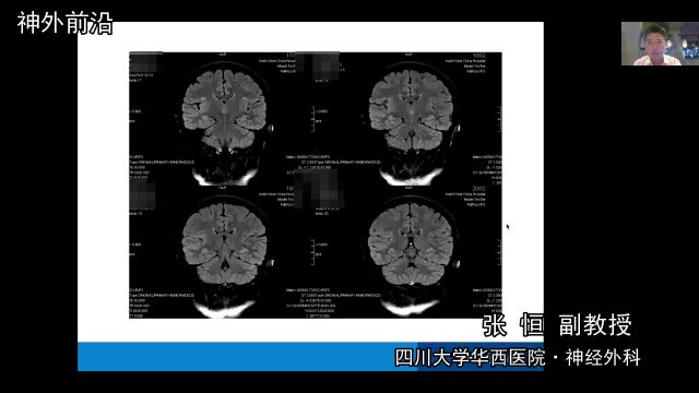 美敦力DBS特刊|专访华西医院张恒:如何客观看待难治性癫痫DBS治疗的价值