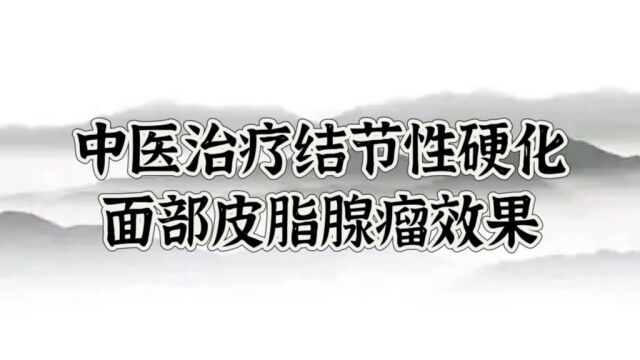 北京珍一堂中医高铁军讲解:中医治疗结节性硬化面部皮脂腺瘤效果如何