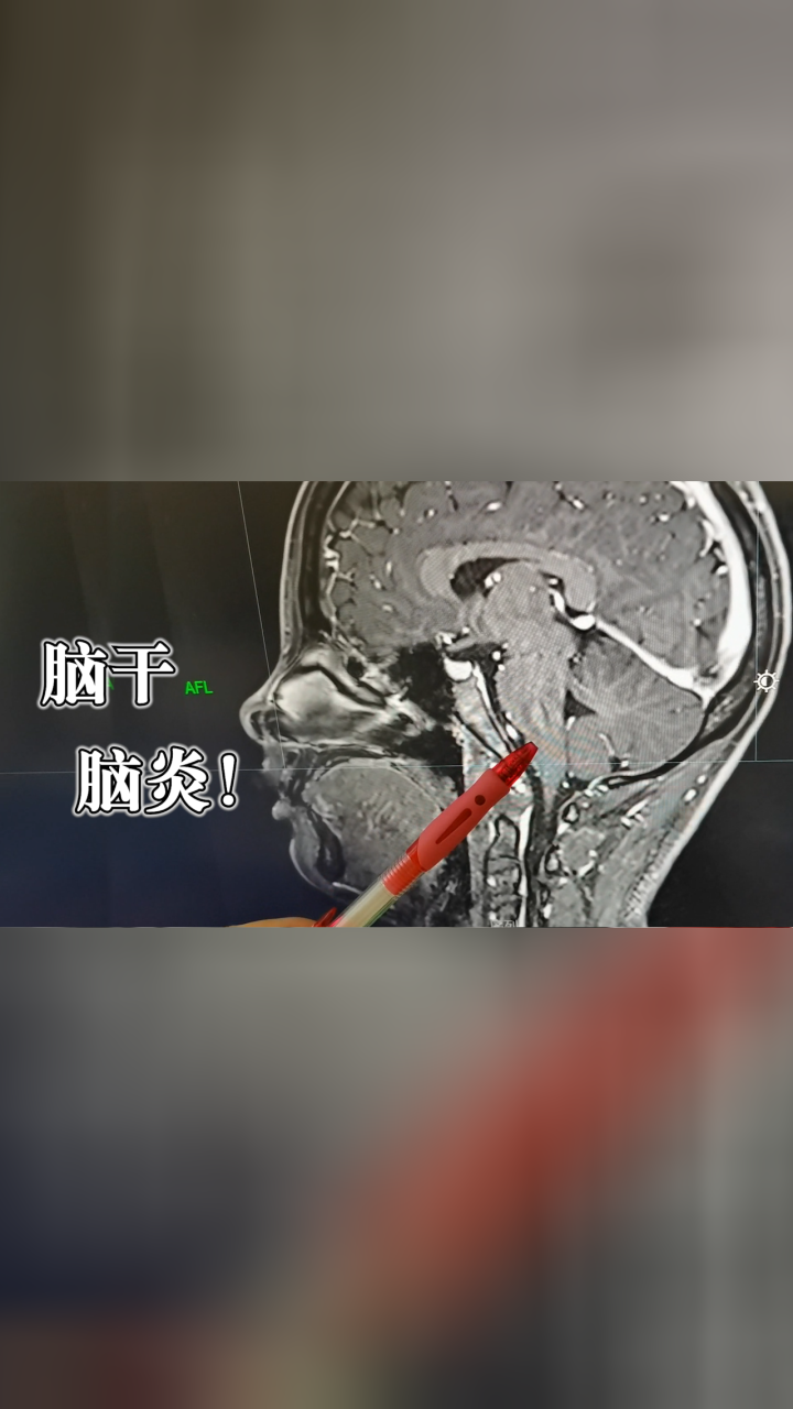 女子一觉睡醒大脑宕机不识亲妈,医生:脑干脑炎引起意识障碍