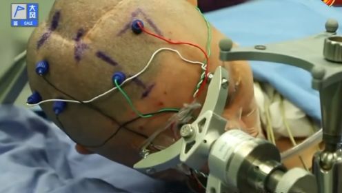 即使用上最先进的设备，医生仍不敢松懈，这是患者第四次开颅手术