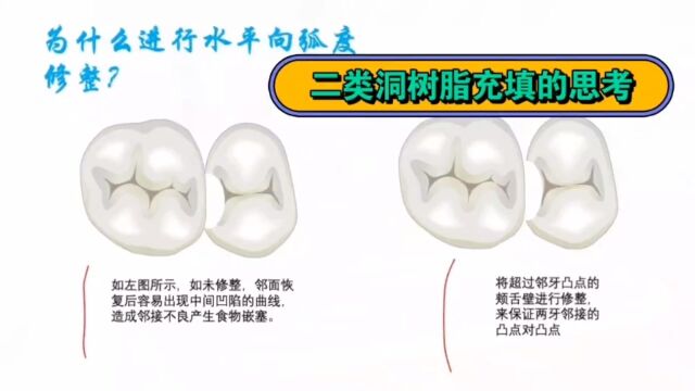 补牙~二类洞树脂充填修复细节与思考