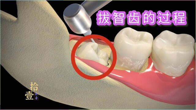 一分钟了解拔智齿的全过程,原来拔牙这么简单啊,你拔过智齿吗?