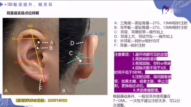 精灵耳(耳基底)注射方法