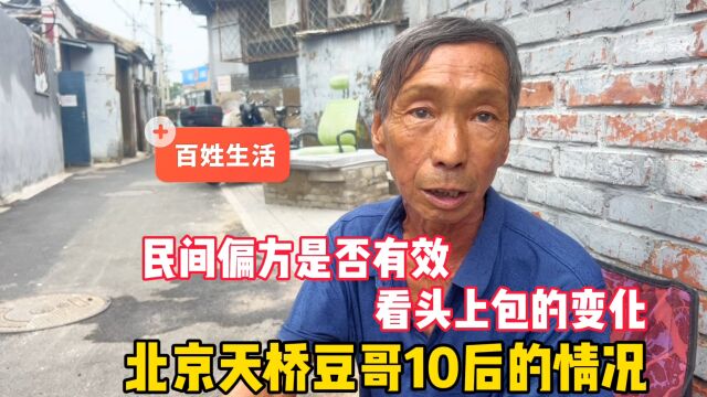 民间偏方管用吗?北京天桥豆哥10天后情况,看头上脓包的变化