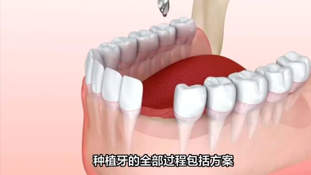 种植牙详细流程讲解