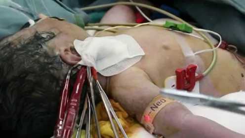 2.5公斤新生儿出生就插上人工心肺