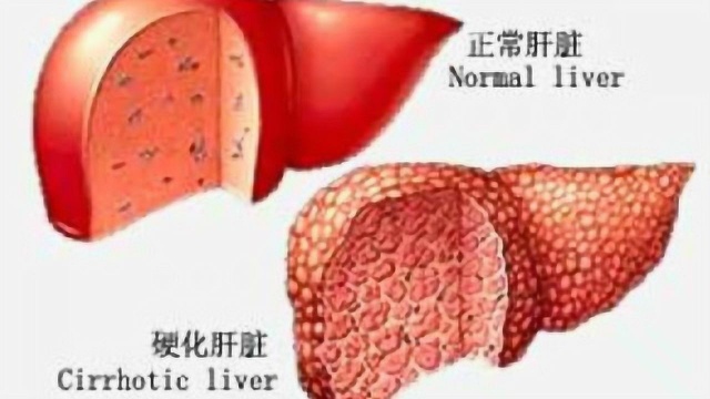 肝硬化病人的早期症状你知道多少