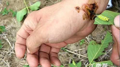 被洋辣子黄刺蛾幼虫蛰伤这样处理可以迅速减轻疼痛