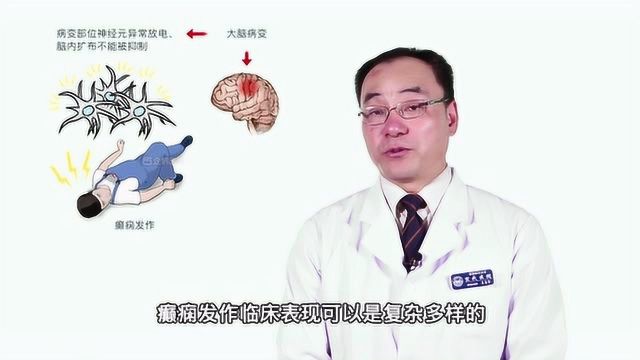 腾讯医典ⷮŠ癫痫有哪些症状?