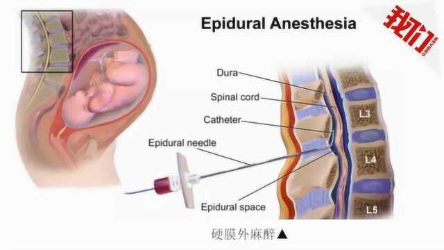 国家将全国推广无痛分娩 专家分析难点:没有那么多人力物力