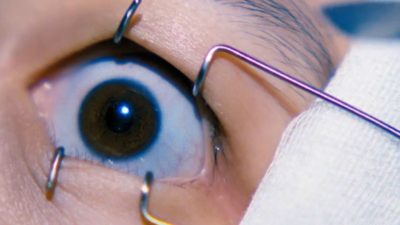 捐献一个眼角膜,可以供几个人使用?眼科专家说出实话