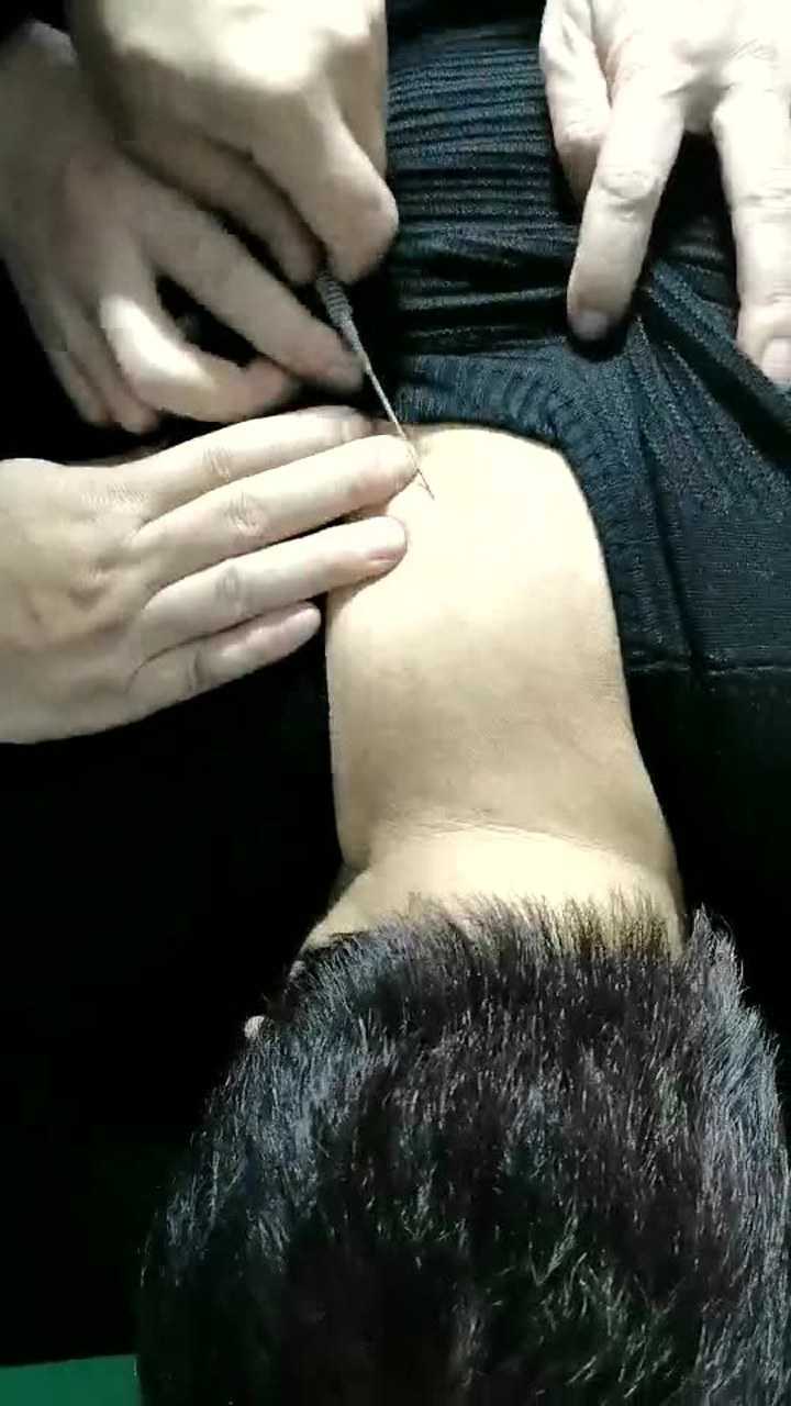 刘念来莽针一针治疗富贵包