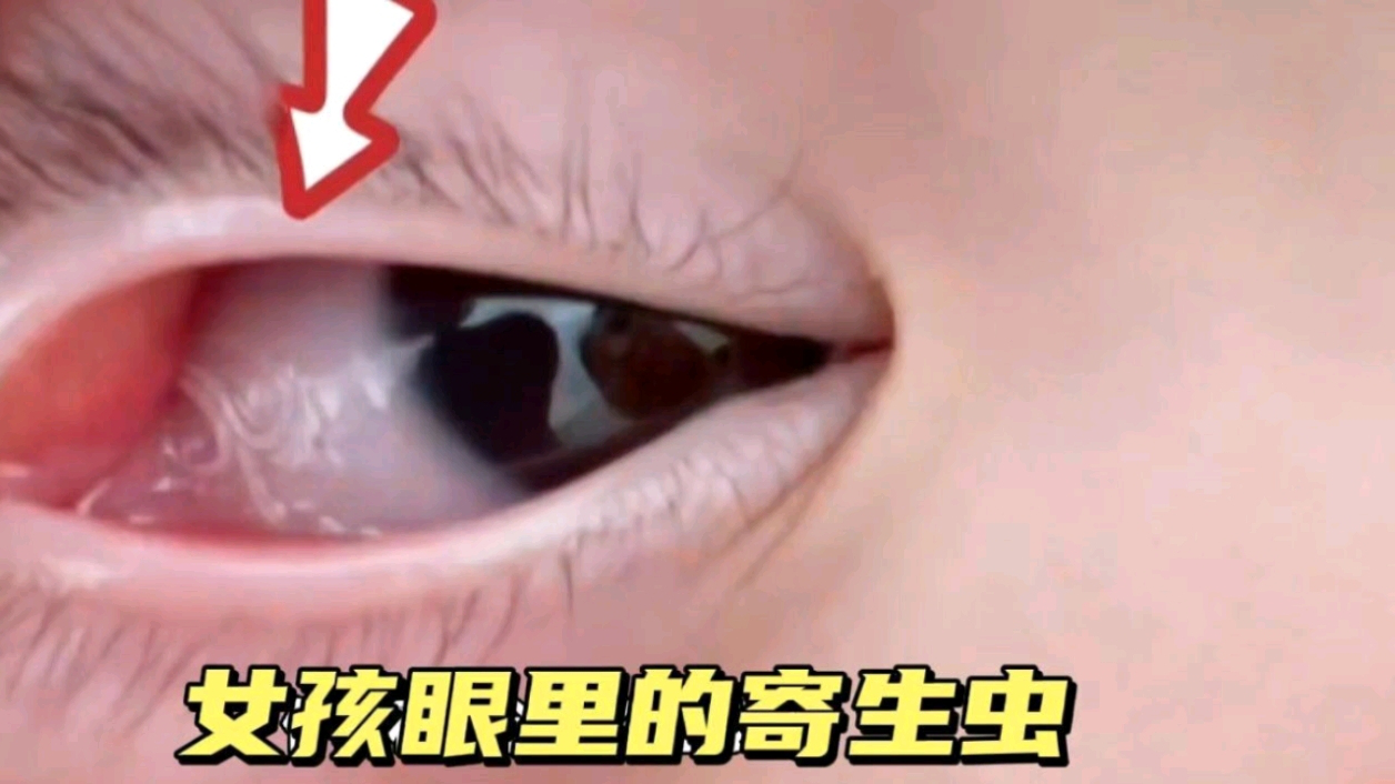 第一集,三岁女孩眼睛长了寄生虫,姥姥扒开一看脸色猛然大变