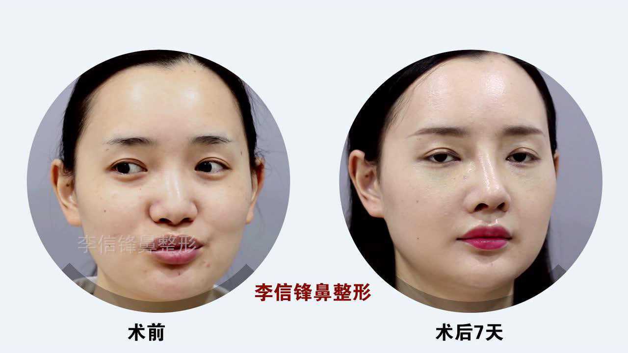 【李信锋鼻整形】半肋鼻综合 初鼻案例 10天对比