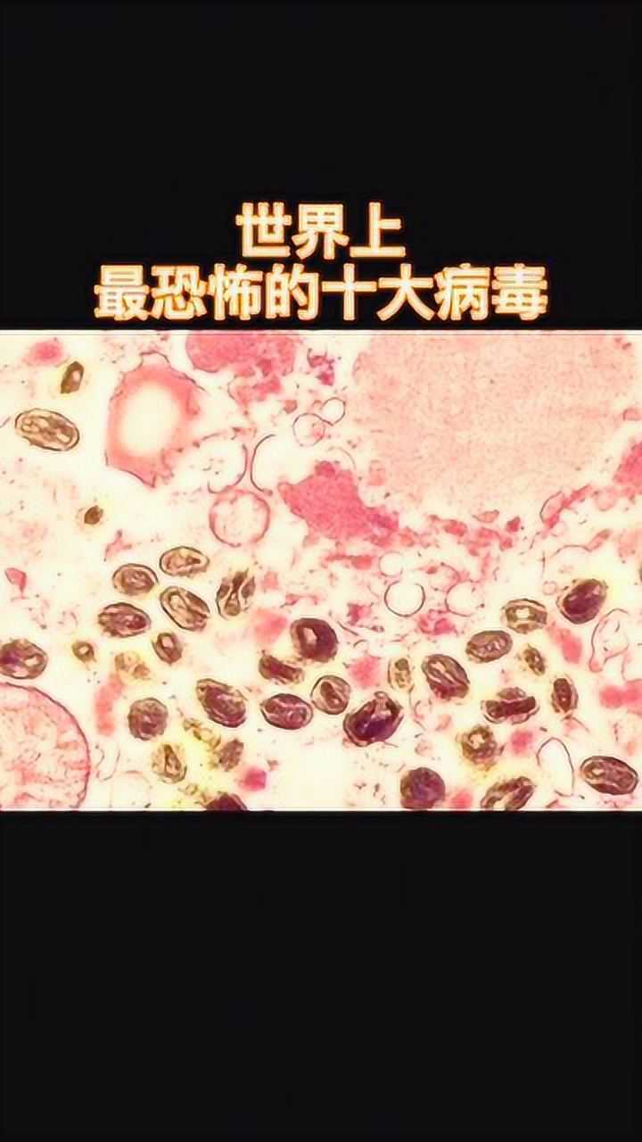 世界上最恐怖的十大病毒,天花死亡率最高,但已被人类征服_腾讯视频
