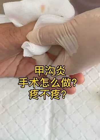 甲沟炎手术切开引流,效果非常棒