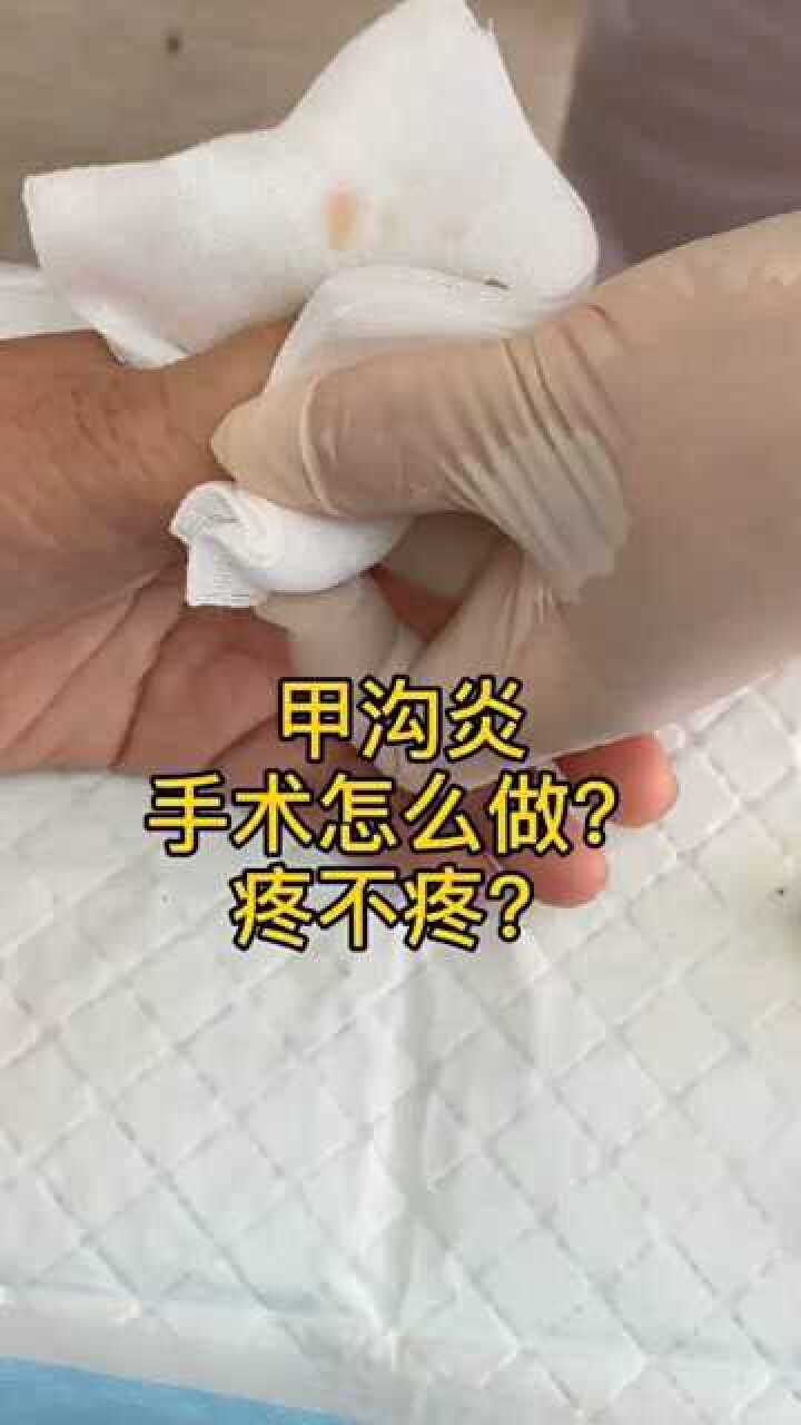 甲溝炎手術切開引流,效果非常棒