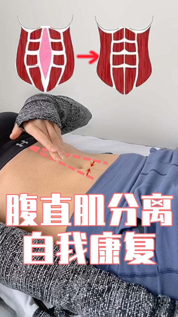 修复腹直肌分离,重获小蛮腰,拒绝当"小腹婆"