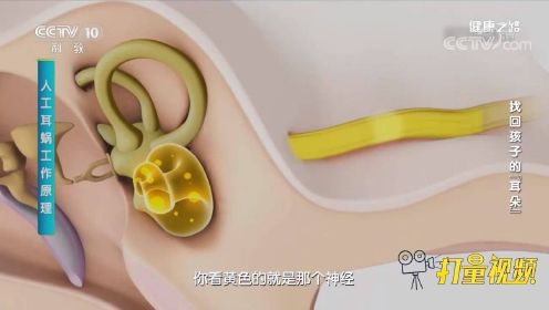 到底什么是人工耳蜗？一段动画演示其工作原理，来看看