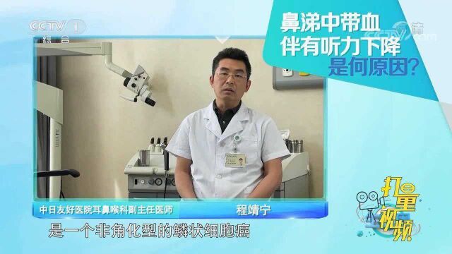 鼻子出血如何处理?专家教你正确方法,很多人都做错了