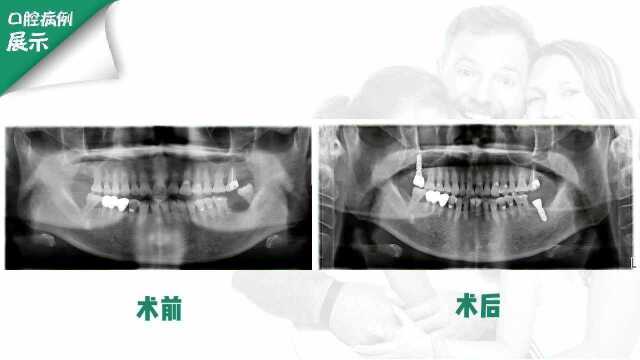 牙齿种植修复案例分享~ 博诚口腔