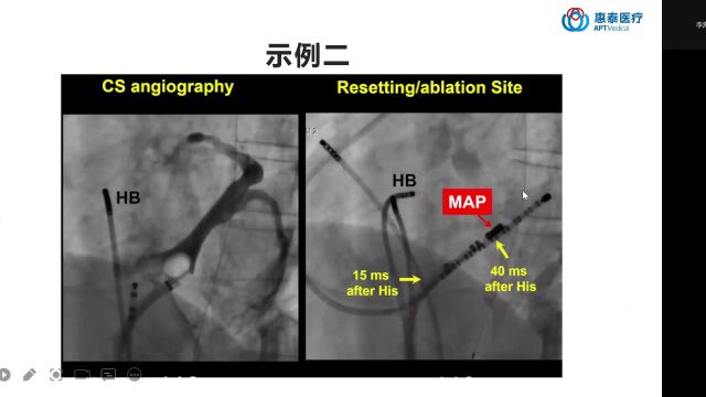 复杂AVNRT标测和消融二