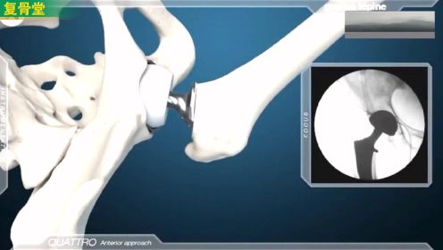 股骨头坏死手术假体置换丨3D动画演示