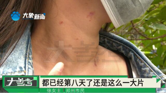 河南郑州:家中未装窗纱,睡醒被隐翅虫“毁容”?女子:像被泼了硫酸一样!